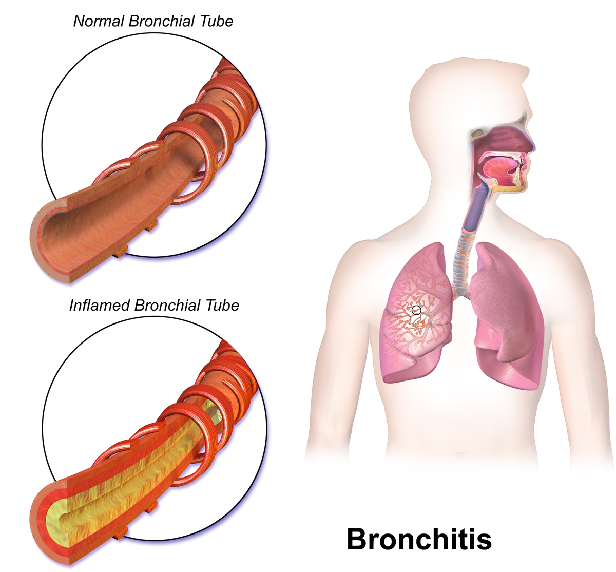 Ayurvedic home remedies for Bronchitis