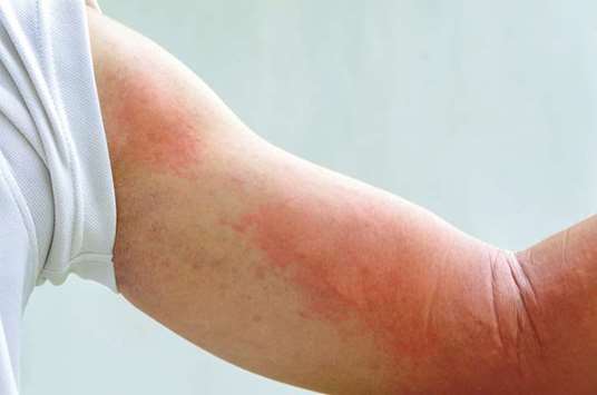 HMC expert offers advice on insect bites